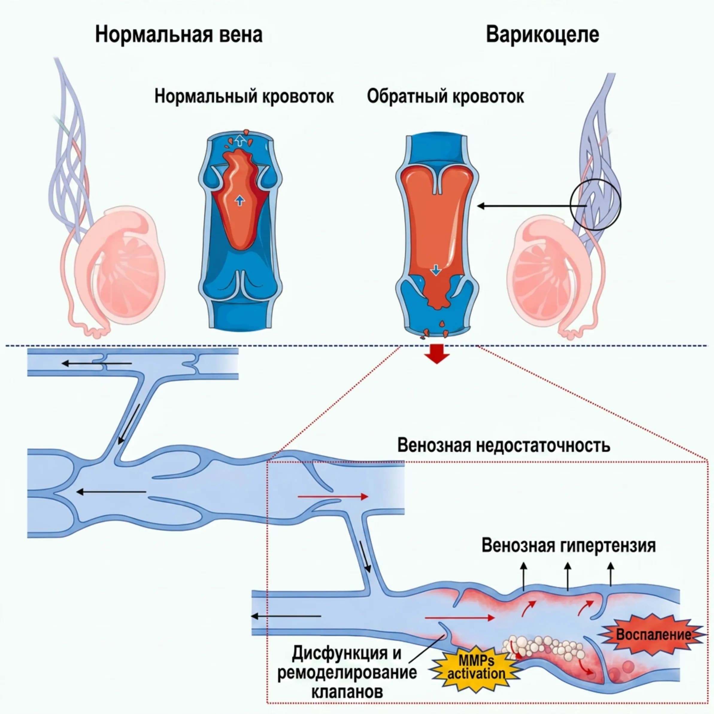 Схема нормальной и недостаточной венозной клапановой системы